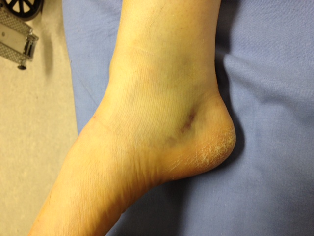 Medial bruising